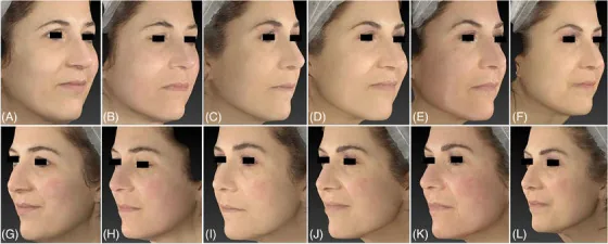 Laser de CO2 antes e depois em rejuvenescimento facial: evolução do pré-tratamento até 1 mês após duas sessões