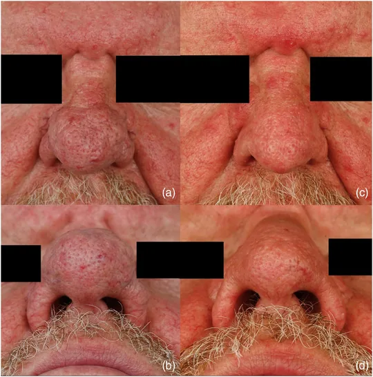 Laser de CO2 antes e depois em rinofima grave do nariz, resultado 3 meses após o procedimento