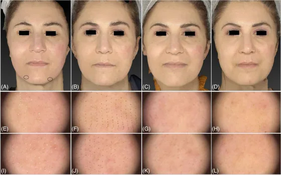 Laser de CO2 antes e depois: recuperação da pele em 3 dias, 14 dias e 1 mês após o tratamento de fotoenvelhecimento