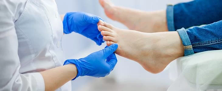 Micose nos pés (pé de atleta): avaliação com dermatologista