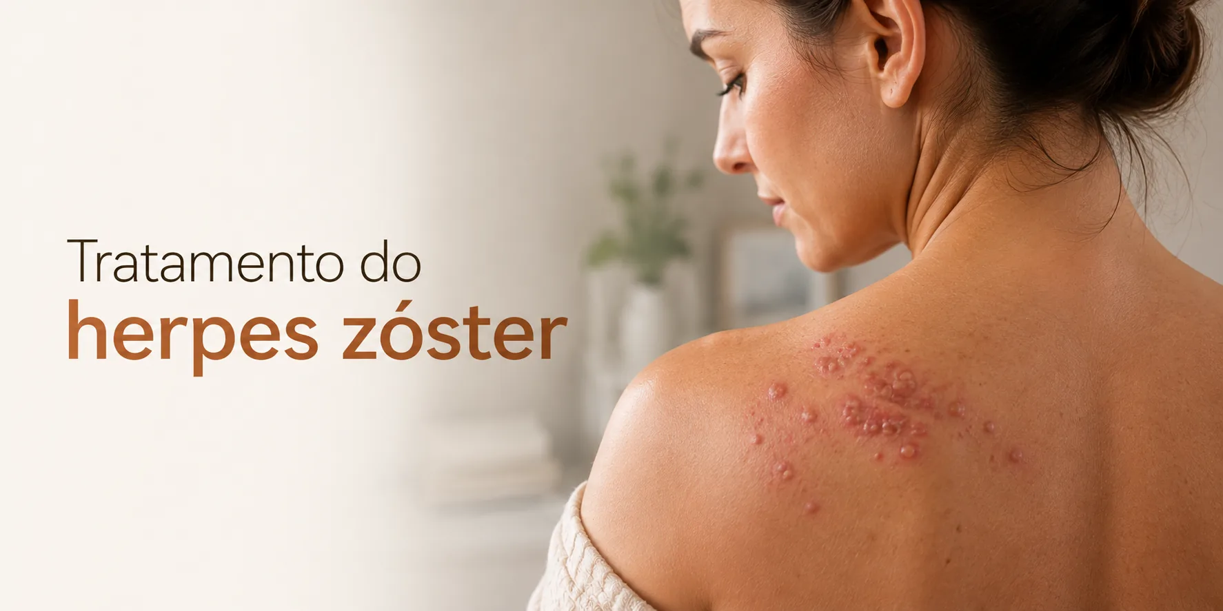 Tratamento do Herpes Zoster