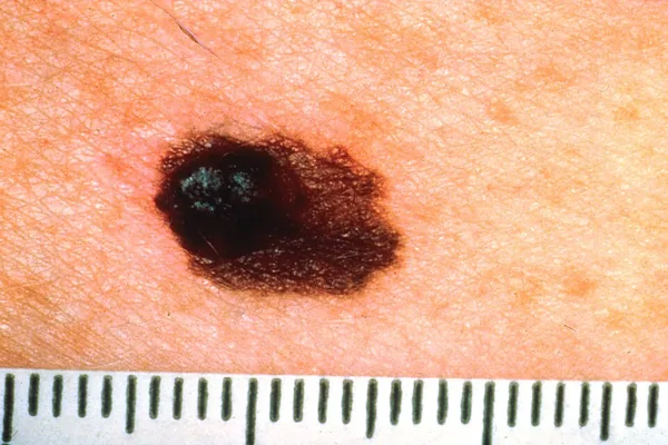 Regra ABCDE do melanoma — A de assimetria: uma metade da lesão é diferente da outra