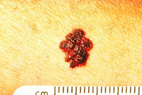 Regra ABCDE do melanoma — B de bordas irregulares, serrilhadas ou mal definidas
