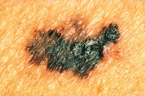 Regra ABCDE do melanoma — C de cor: vários tons de marrom, preto ou castanho na mesma lesão