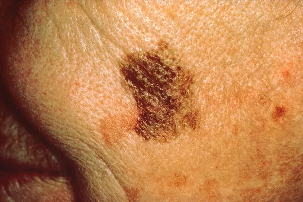 Regra ABCDE do melanoma — D de diâmetro: lesão que cresceu ou tem mais de 6 mm