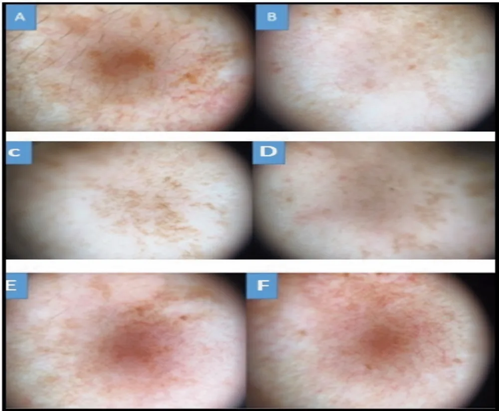 Dermatoscopia de melasma antes e depois de 8 semanas de tratamento