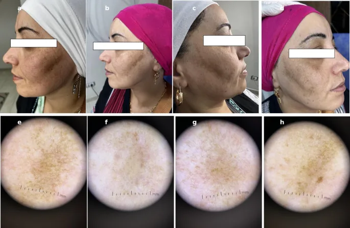 Melasma antes e depois de laser: comparação lado a lado entre 675 nm e Q-switched