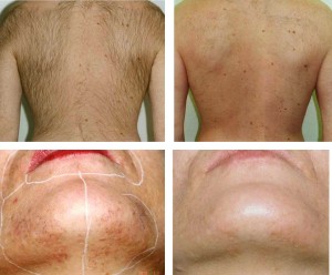 depilação laser antes e depois